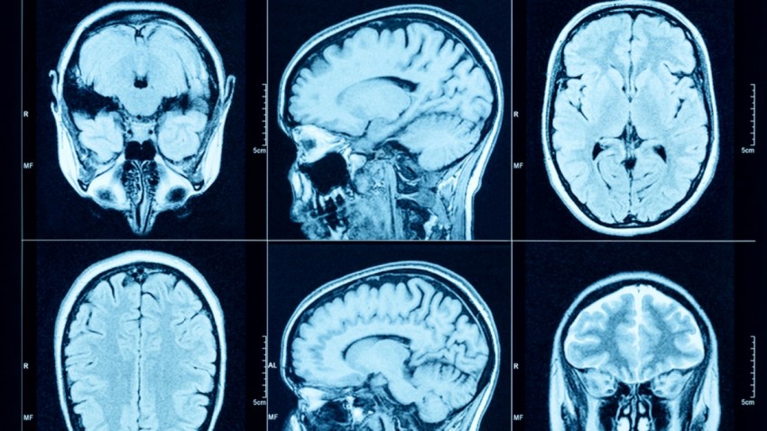 TLMD-cerebro-shutterstock_415540480-