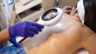 La técnica del “patito feo” y otros tips para prevenir el cáncer de piel