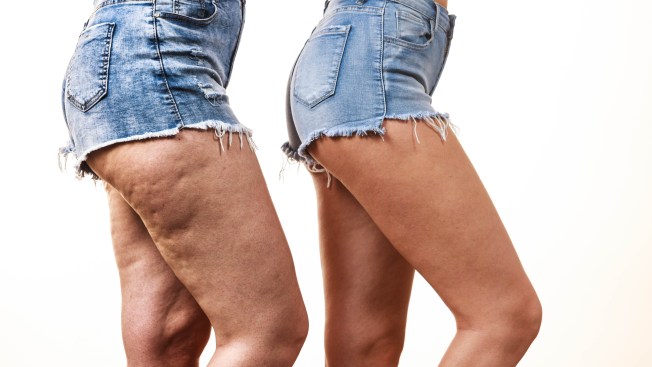 Quitar cirugia grasa las para piernas de